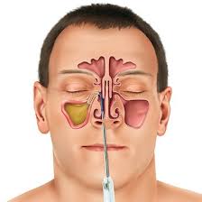 Nose Surgeries
